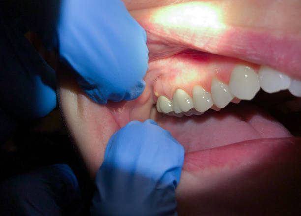 Best Emergency Treatment for Dental Infections or Abscesses in Kingston, WA